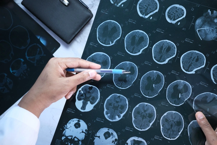 Traumatic Brain Injuries: Causes, Symptoms, and Legal Recourse